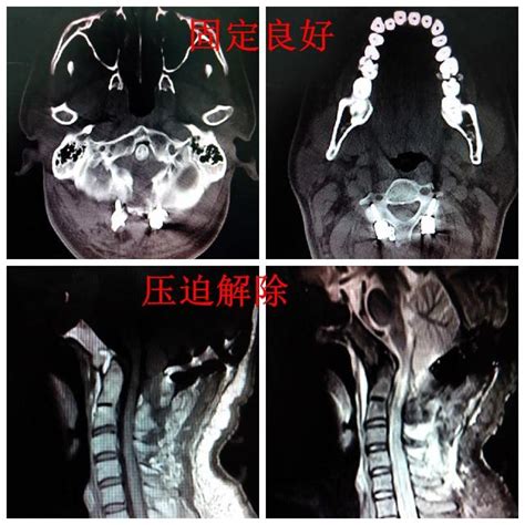 頭頂後方凹陷|顱底凹陷症,顱底凹陷症症状